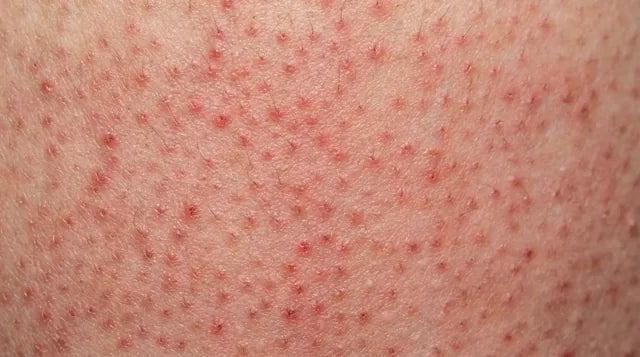Foliculitis por depilación