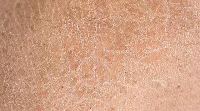 Piel áspera y queratosis pilaris